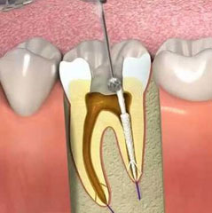 درمان ریشه دندان در بهارستان